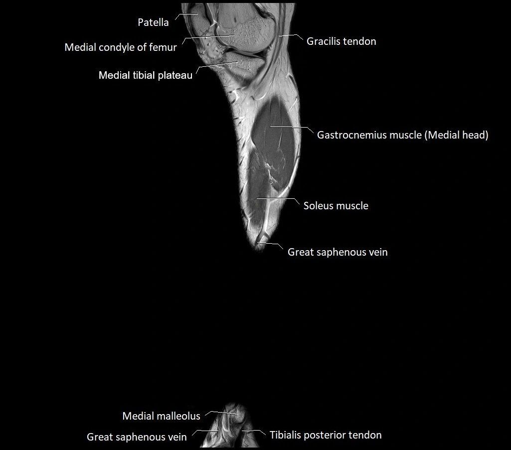 Lower leg sagittal anatomy 3T MRI image 26.webp